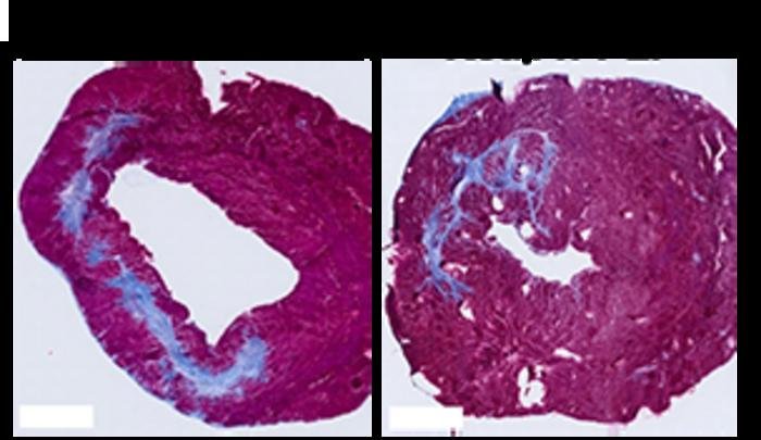 New Therapy Could Help Heart Tissue Heal After Heart Attack