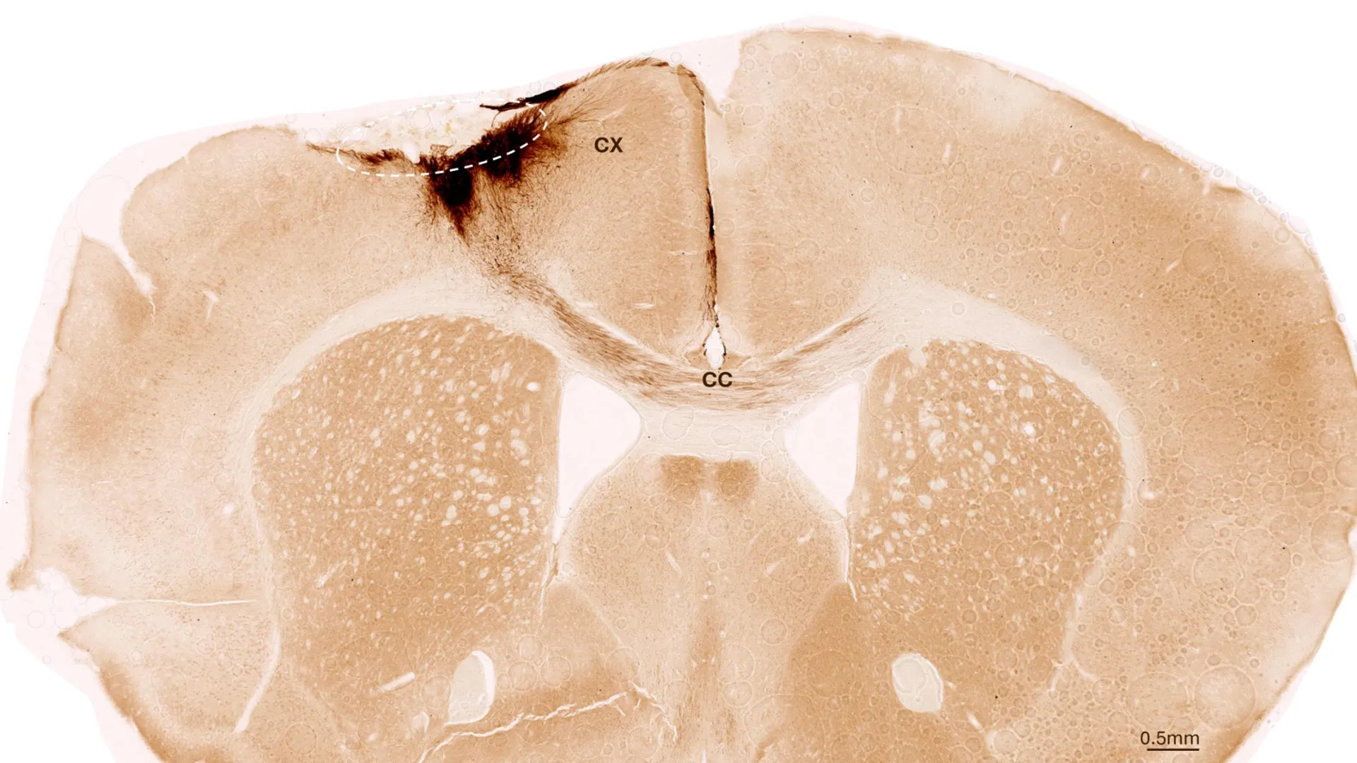 Scientists reverse stroke damage with stem cells